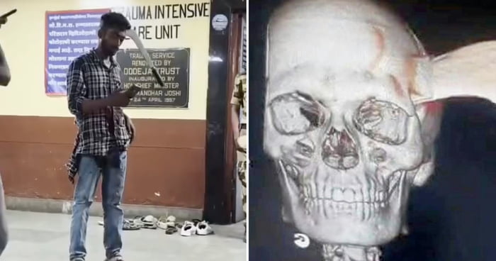 Indian Man With Machete Lodged In Head Calmly Walks Into ICU While Using Phone