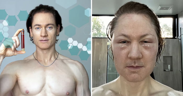 Anti-Aging Influencer Bryan Johnson Reveals He Has Incurable Disease Causing His 'Stomach To Eat Itself'